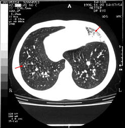 Pulmonary infection