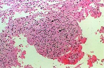 Bronchial granuloma caused by M. abscessus